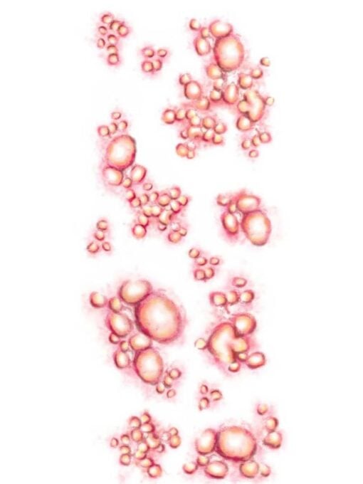 Diseased temporary tattoo